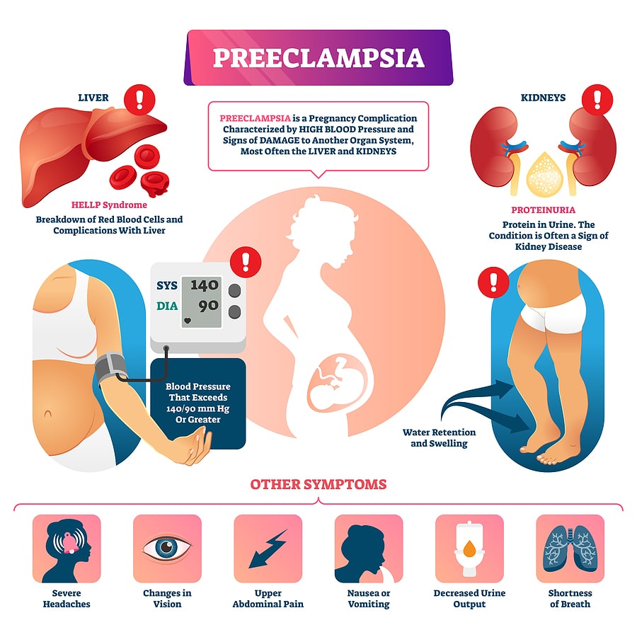 Infographic listing common symptoms of preeclampsia during pregnancy, including high blood pressure, severe headaches, vision changes, and more.