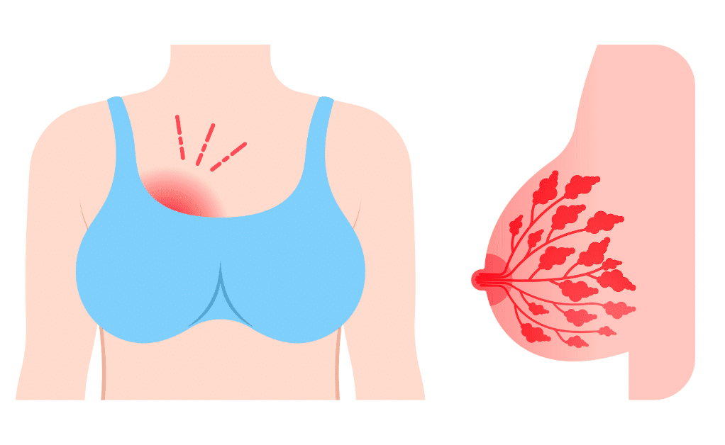 Illustration of a breastfeeding woman with one breast highlighted in red to indicate engorgement.
