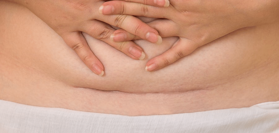 A close-up of a woman’s lower abdomen showing a healed cesarean scar, symbolizing strength, healing, and postpartum recovery.