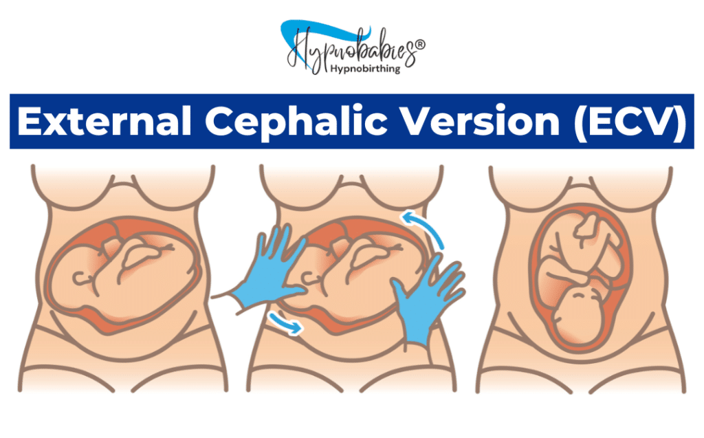 Illustration showing a breech baby turning to a head-down position during an External Cephalic Version (ECV) procedure.