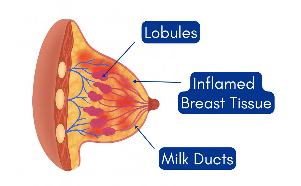 Cross-sectional medical illustration of a breast showing inflamed milk ducts and tissue, commonly seen in mastitis during breastfeeding.