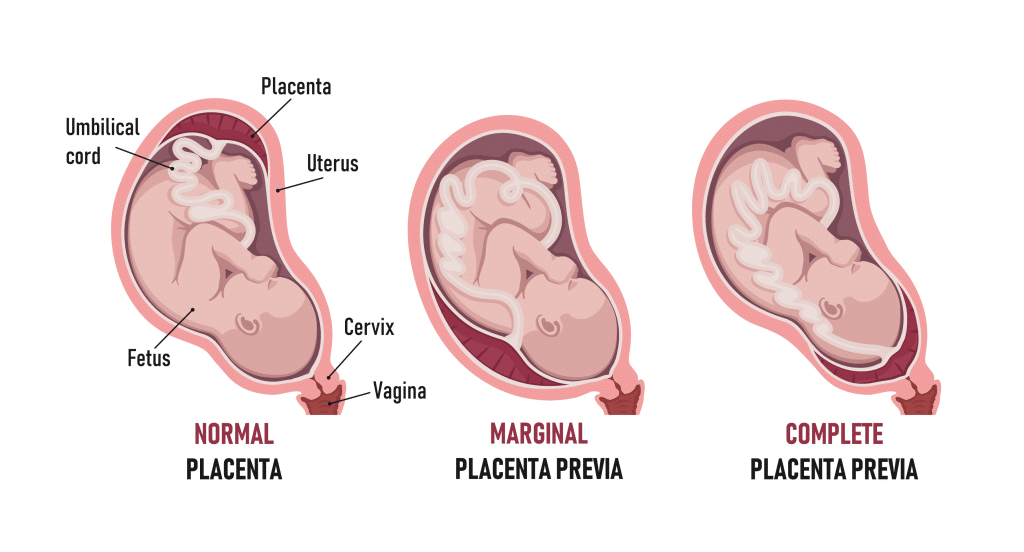 Diagram showing the differences between a normal placenta, partial placenta previa, and complete placenta previa during pregnancy.