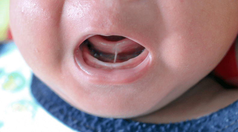 Close-up of a newborn’s open mouth showing a visible tongue tie with the frenulum connecting the tongue to the floor of the mouth.